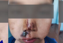 Работников специнтерната в Беловодском подозревают в избиении ребенка с инвалидностью