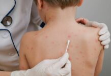 В Бишкеке с начала года ветрянкой заболели почти 4,2 тыс. человек