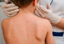 В Кыргызстане заболеваемость ветрянкой выросла в 7,7 раза