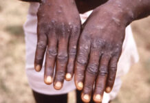 ВОЗ объявила вспышку оспы обезьян чрезвычайной ситуацией в области здравоохранения