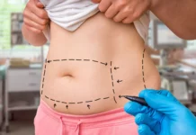 Липосакциядан кийин каза болгон аялдын өлүмү боюнча козголгон кылмыш иши кыскартылды