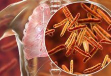 Бишкектеги №33 мектептин мугалиминен кургак учук оорусу аныкталды