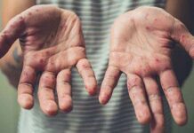 Бишкекте кызамык оорусунун 4 учуру катталды