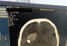 Башына ок тийип, оор абалда түшкөн жаранды кыргызстандык врачтар сактап калды