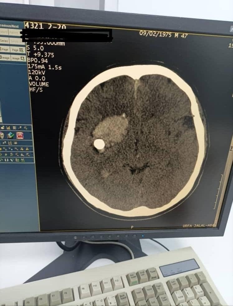 cc802e34 fb63 4849 9496 8c33708e2898 В Джалал-Абаде нейрохирурги спасли пациента с пулей в голове