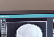 “Жыгылып кетип, колундагы кайчы бетине сайылган”: Кайчыны дарыгерлер алып чыгышты