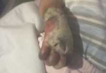 Министрдин көзөмөлүндө: Колунан ажыраган ымыркайдын окуясы боюнча кызматтык иликтөө жүргүзүлүүдө