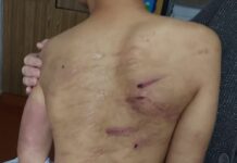 Осторожно, фото! Отец жестоко избивал сына, вся спина ребенка в шрамах