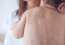 В Кыргызстане напряженная ситуация с корью, — Минздрав