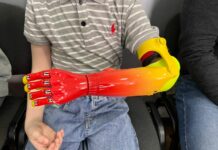 Для 13 маленьких кыргызстанцев бесплатно изготовили протезы рук «Киби»