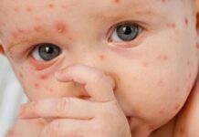 Кыргызстанда кызамык жана кызылча оорусу көп катталууда