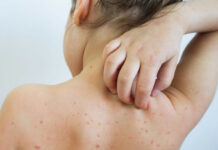 В Кыргызстане растет заболеваемость корью