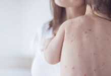 В Кыргызстане растет заболеваемость корью и краснухой