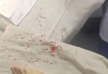 Сузак районунда чөп чапкан трактор 13 жаштагы кыздын бутун кесип кетти