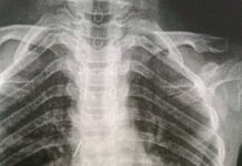 Ошто дарыгерлер канцелярдык мык жутуп алган баланы куткарышты