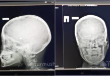 В Аксы в тире ребенку прострелили голову, пуля застряла в мозге