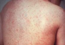 Кызамык менен ооруган 3 жаштагы наристе чарчап калды