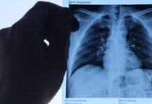 Эхинококкозом в Кыргызстане болеют целые семьи, много летальных исходов