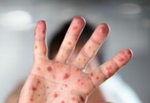 Вспышка кори. В Кыргызстане стартовала кампания по иммунизации