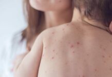 Кыргызстанда жыл башынан бери кызамык оорусунун 2,3 учуру катталды