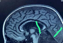 В Бишкеке врачи удалили из мозга восьмилетней девочки клочок волос