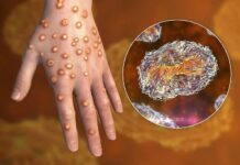 В Кыргызстане оспа обезьян не зарегистрирована, но принимаются меры предосторожности