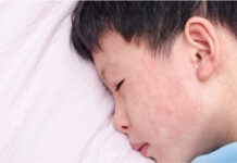 Почему важна повторная вакцинация от кори: рекомендации для взрослых в Кыргызстане