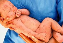 Корь и уязвимые группы населения: как вакцинация защищает беременных женщин и младенцев Кыргызстана