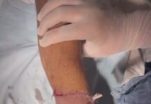 Врачи Нацгоспиталя успешно пришили мужчине оторванную кисть