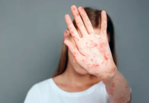 Ситуация с заболеваемостью корью в Кыргызстане остаётся острой — Минздрав