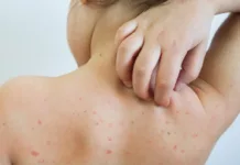 За два месяца от кори в Кыргызстане умерли 8 детей. Власти бьют тревогу