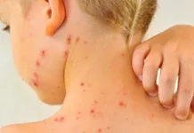 Вспышка кори в Кыргызстане. Зарегистрировано около 5 тыс. случаев заболевания